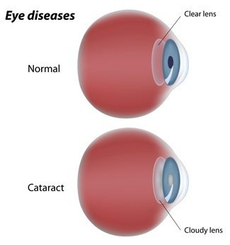 eye-diseases-illustration